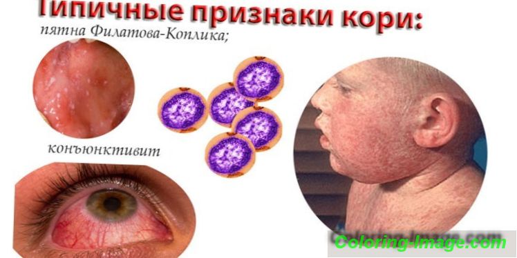 Симптомите на дребната морбили и ранните признаци