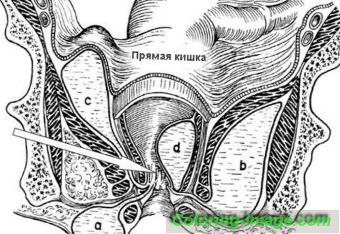 Paraproctitis латынь. Ишиоректальный парапроктит.