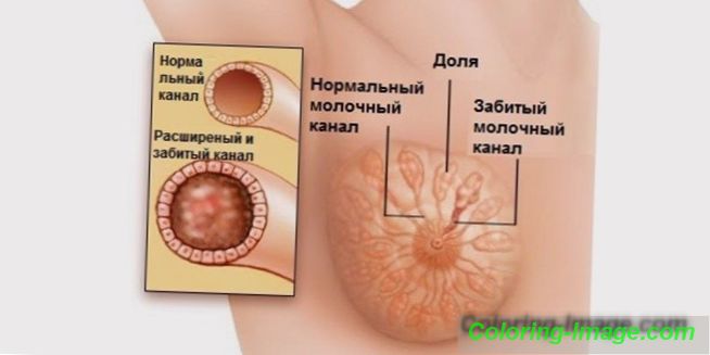 Лактостаза при кърмеща майка: симптоми и лечение на млякото в гърдата