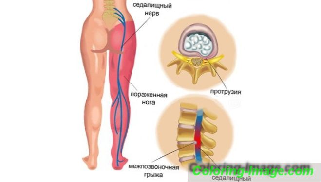 Sevřený ischiasický nerv: symptomy a léčba doma