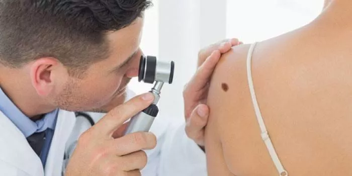 Melanoformni nevus trupa i kože - znakovi, dijagnoza, terapija, uklanjanje i prevencija