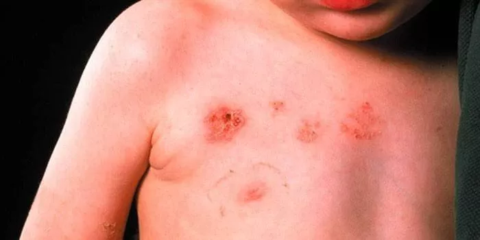 Vrste dermatitisa kod odraslih i djece - koje su manifestacije, uzroci i liječenje